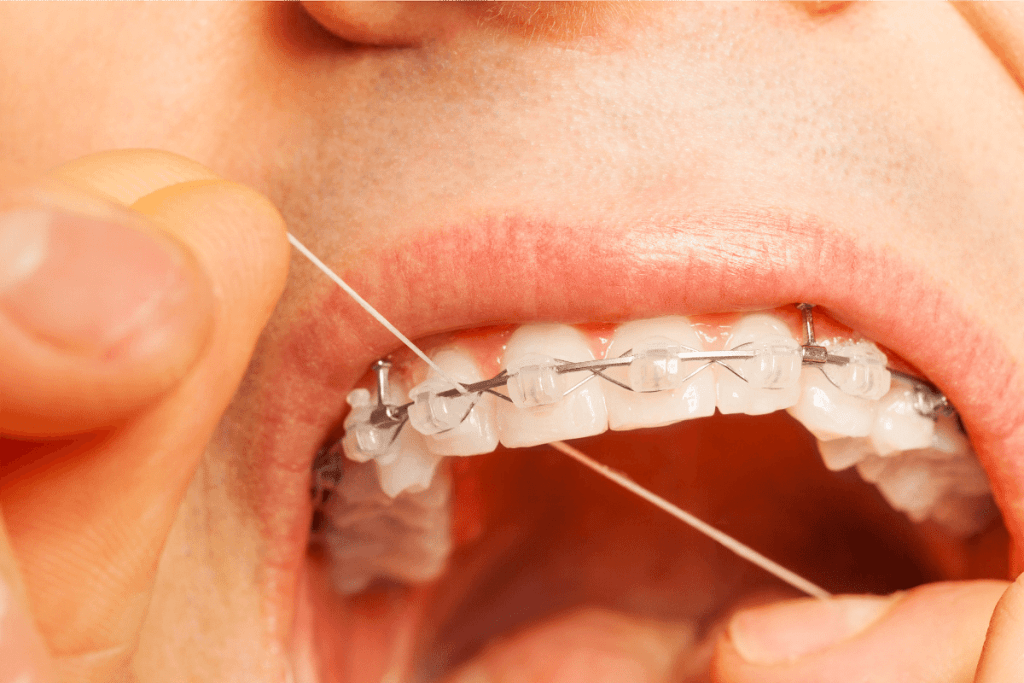 The Ultimate Guide On How To Floss With Braces Orthodontist in Salt