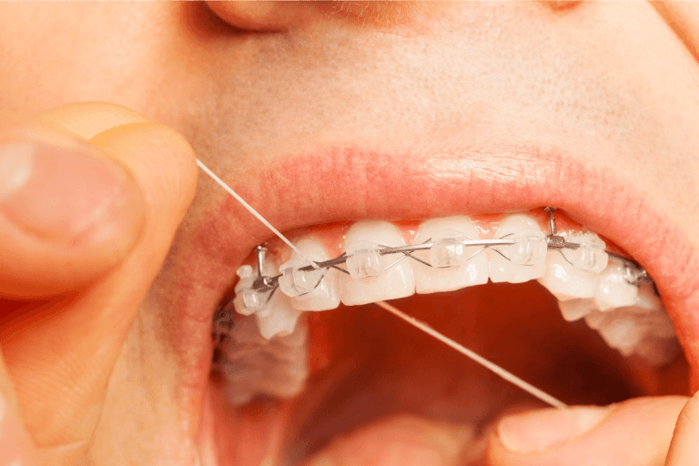 The Ultimate Guide On How To Floss With Braces Orthodontist in Salt